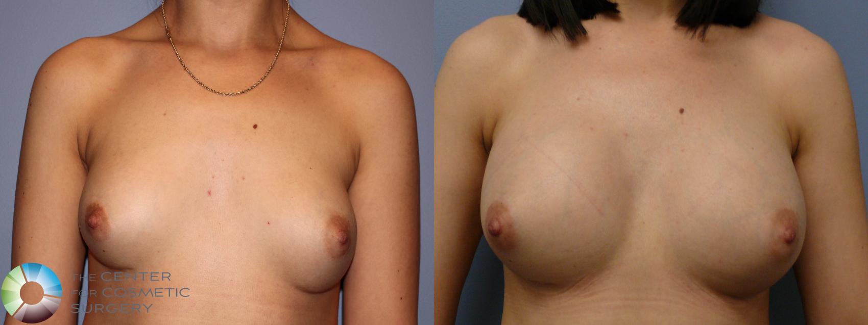 Before & After Breast Augmentation Case 11263 Front View in Golden, CO