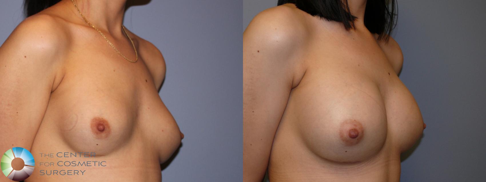 Before & After Breast Augmentation Case 11263 Right Oblique in Denver and Colorado Springs, CO