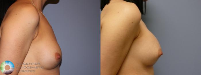 Before & After Breast Augmentation Case 11263 Right Side View in Golden, CO