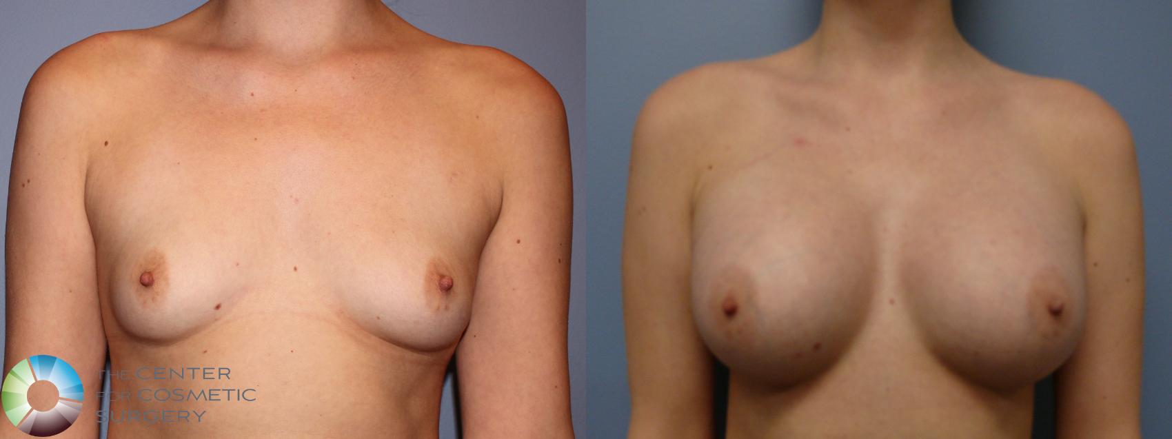 Before & After Breast Augmentation Case 11264 Front View in Golden, CO