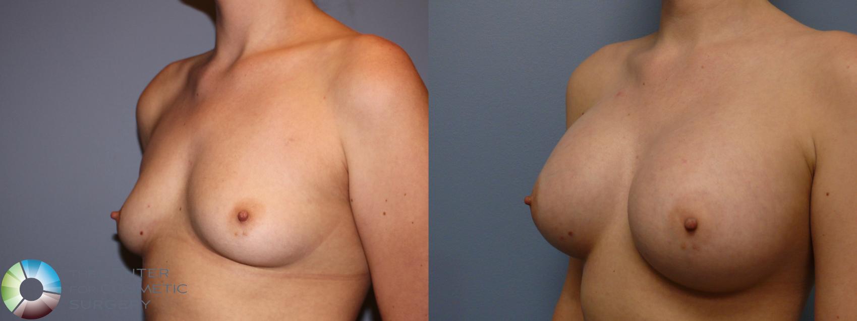 Before & After Breast Augmentation Case 11264 Left Oblique in Denver and Colorado Springs, CO
