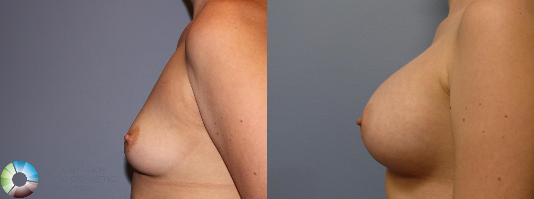 Before & After Breast Augmentation Case 11264 Left Side in Denver and Colorado Springs, CO