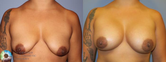 Before & After Breast Augmentation Case 11265 Front in Denver, CO