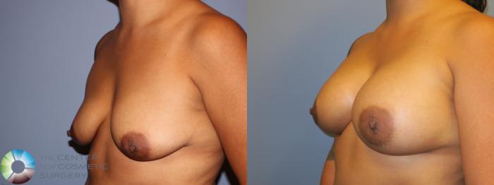 Before & After Breast Augmentation Case 11265 Left Oblique in Denver, CO
