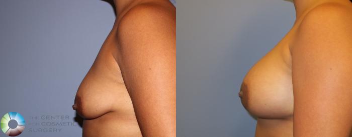 Before & After Breast Augmentation Case 11265 Left Side in Denver, CO