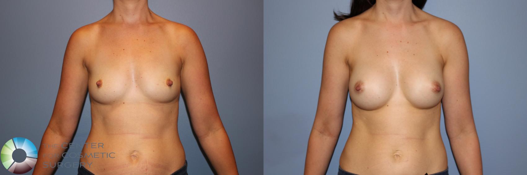 Before & After Breast Augmentation Case 11273 Front View in Golden, CO