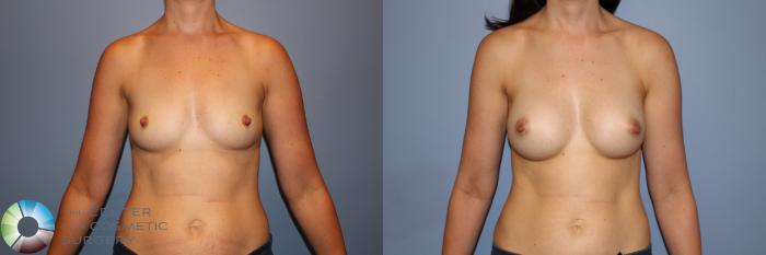 Before & After Breast Augmentation Case 11273 Front in Denver and Colorado Springs, CO