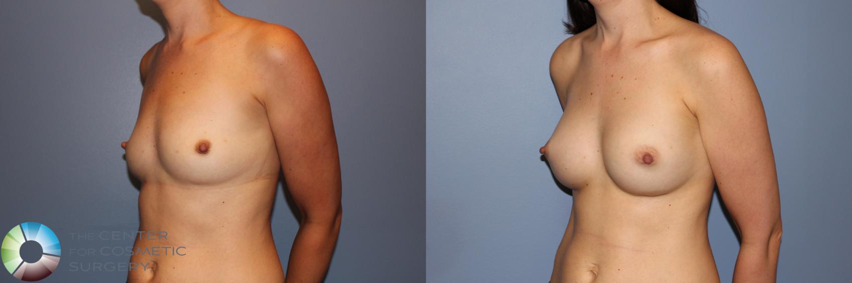 Before & After Breast Augmentation Case 11273 Left Oblique View in Golden, CO