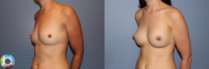 Before & After Breast Augmentation Case 11273 Left Oblique in Denver and Colorado Springs, CO