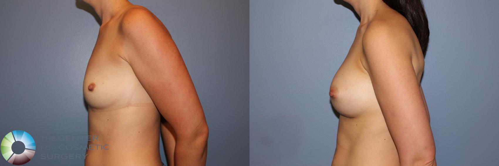 Before & After Breast Augmentation Case 11273 Left Side View in Golden, CO