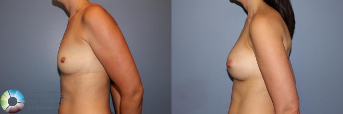 Before & After Breast Augmentation Case 11273 Left Side in Denver and Colorado Springs, CO