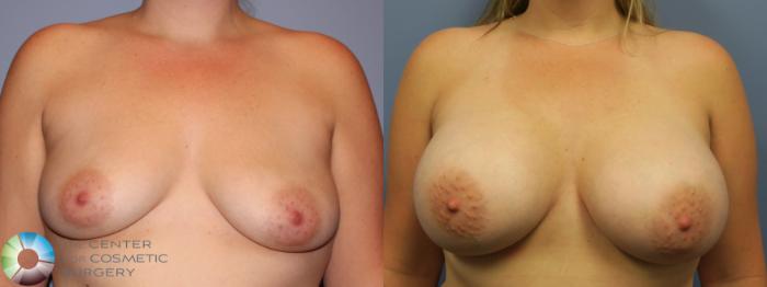 Before & After Breast Augmentation Case 11283 Front in Denver and Colorado Springs, CO