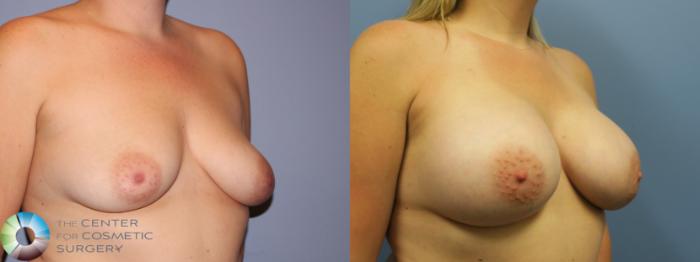 Before & After Breast Augmentation Case 11283 Right Oblique in Denver and Colorado Springs, CO