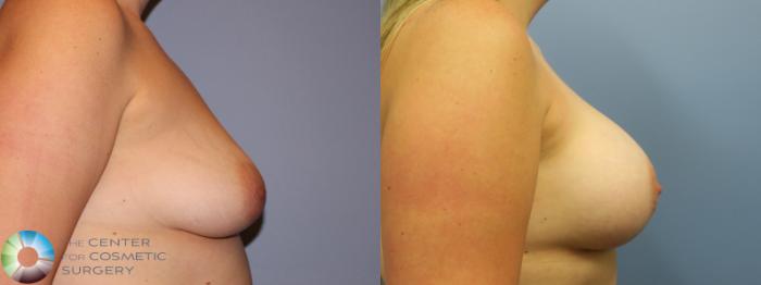 Before & After Breast Augmentation Case 11283 Right Side in Denver and Colorado Springs, CO
