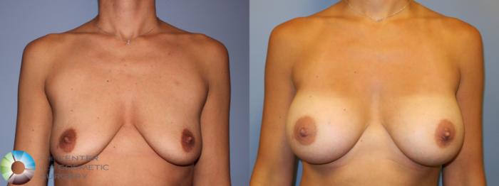 Before & After Breast Augmentation Case 11284 Front in Denver and Colorado Springs, CO