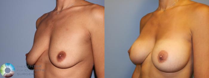 Before & After Breast Augmentation Case 11284 Left Oblique in Denver and Colorado Springs, CO