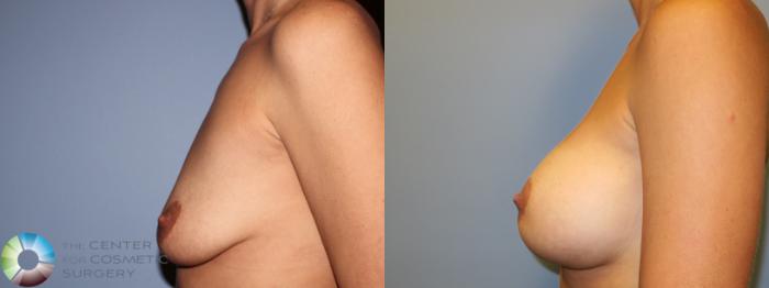 Before & After Breast Augmentation Case 11284 Left Side in Denver and Colorado Springs, CO