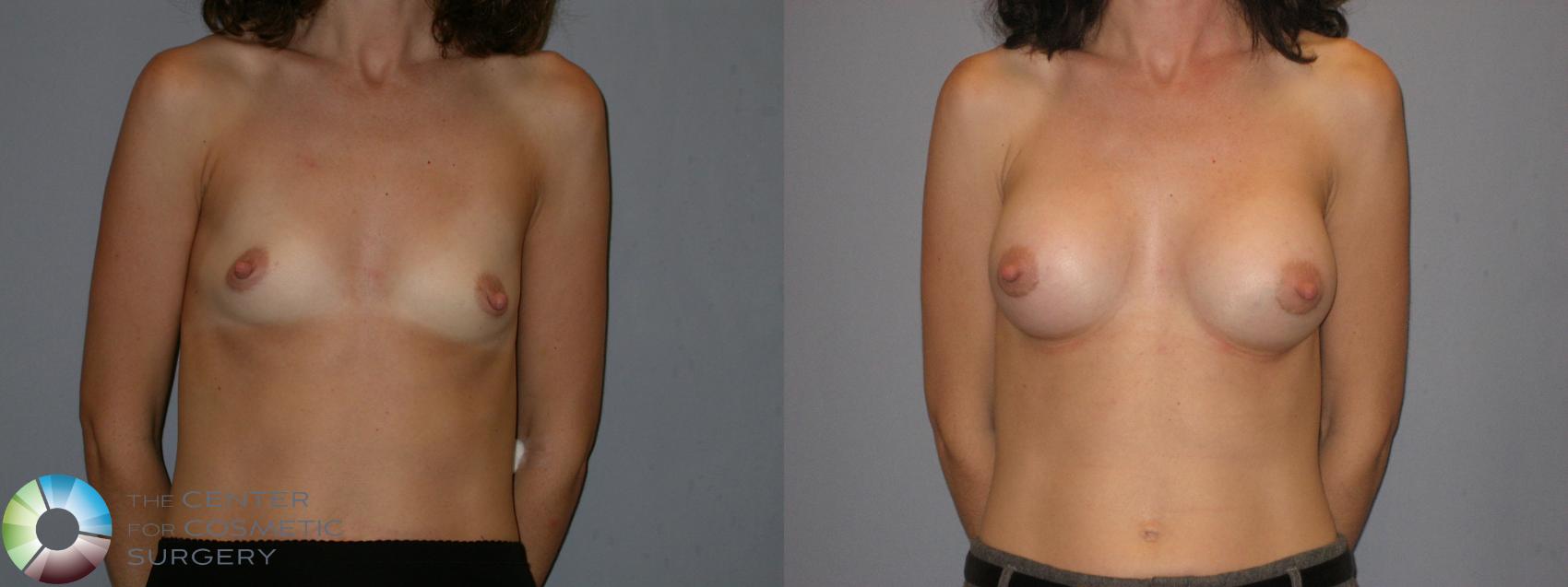 Before & After Breast Augmentation Case 113 View #1 in Denver and Colorado Springs, CO