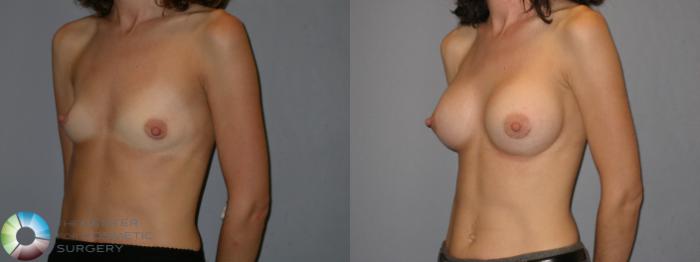 Before & After Breast Augmentation Case 113 View #2 View in Golden, CO