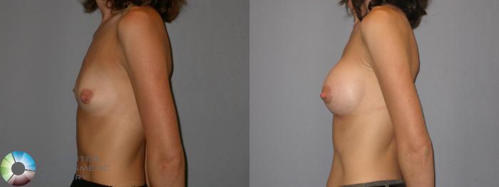 Before & After Breast Augmentation Case 113 View #3 View in Golden, CO