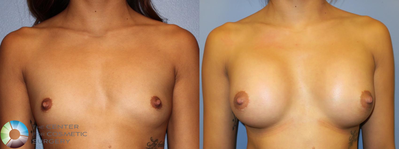Best Denver Breast Augmentation