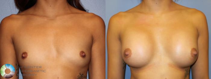 Before & After Breast Augmentation Case 11300 Front in Denver and Colorado Springs, CO