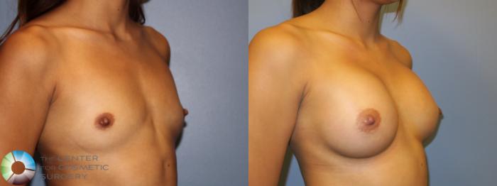 Before & After Breast Augmentation Case 11300 Right Oblique in Denver and Colorado Springs, CO