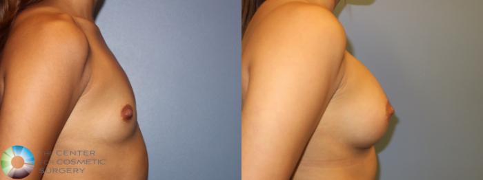 Before & After Breast Augmentation Case 11300 Right Side in Denver and Colorado Springs, CO
