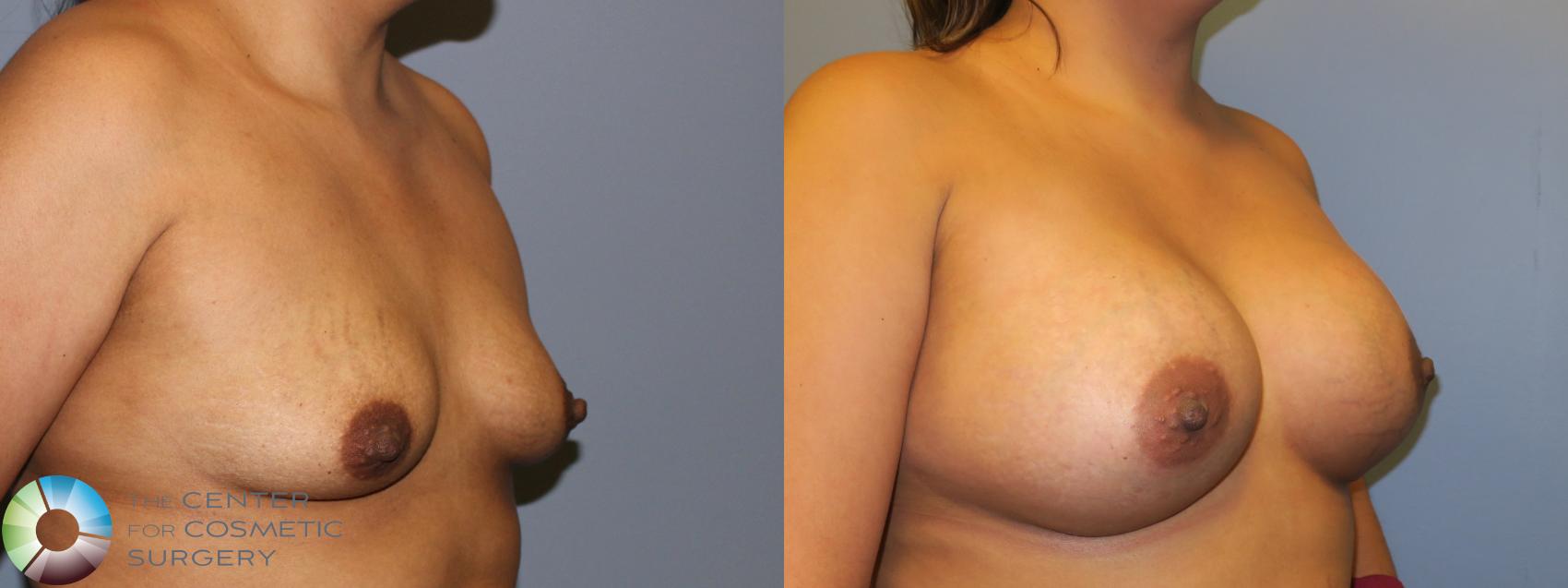 Before & After Breast Augmentation Case 11301 Right Oblique in Denver and Colorado Springs, CO