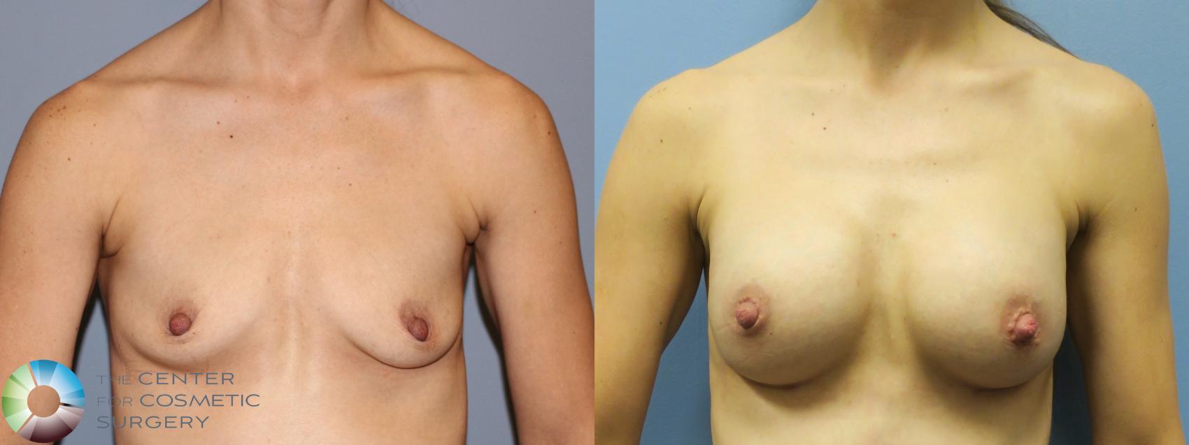 Before & After Breast Augmentation Case 11316 Front in Denver and Colorado Springs, CO