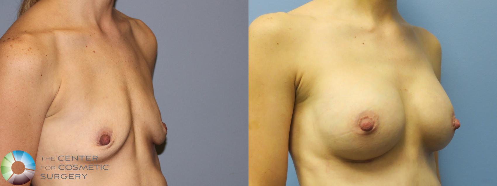 Before & After Breast Augmentation Case 11316 Right Oblique in Denver and Colorado Springs, CO