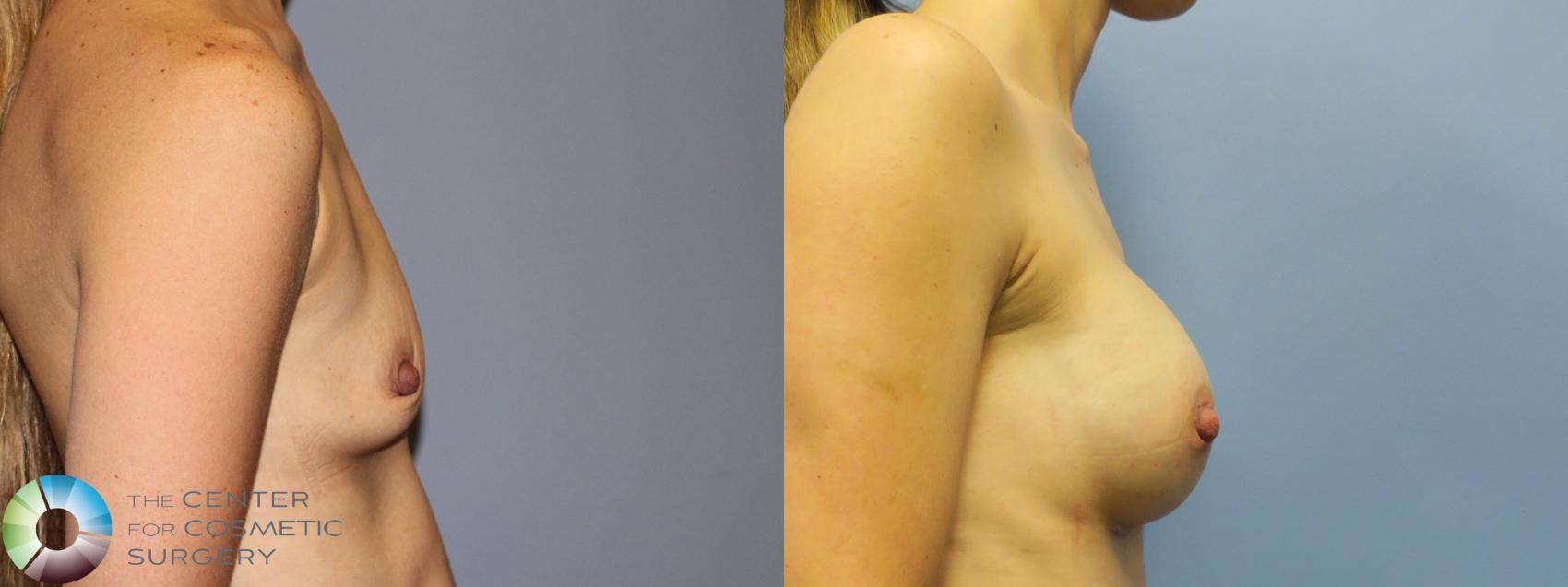 Before & After Breast Augmentation Case 11316 Right Side in Denver and Colorado Springs, CO