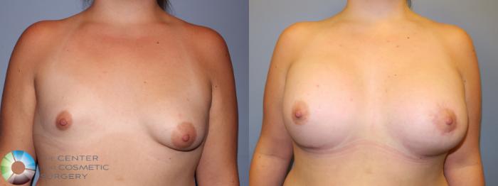 Before & After Breast Augmentation Case 11317 Front in Denver and Colorado Springs, CO