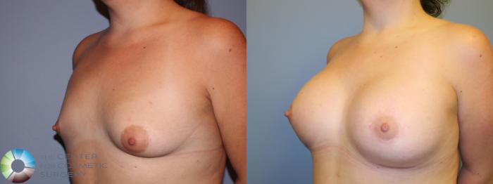 Before & After Breast Augmentation Case 11317 Left Oblique in Denver and Colorado Springs, CO