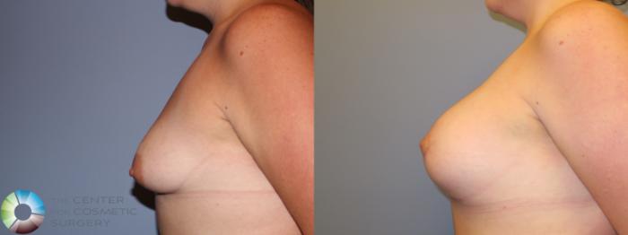Before & After Breast Augmentation Case 11317 Left Side in Denver and Colorado Springs, CO
