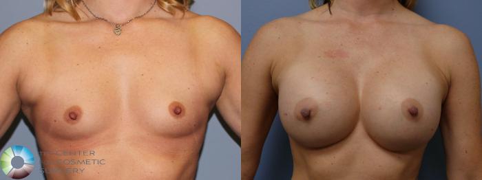 Before & After Breast Augmentation Case 11318 Front View in Golden, CO
