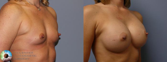 Before & After Breast Augmentation Case 11318 Right Oblique View in Golden, CO