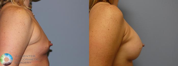 Before & After Breast Augmentation Case 11318 Right Side View in Golden, CO