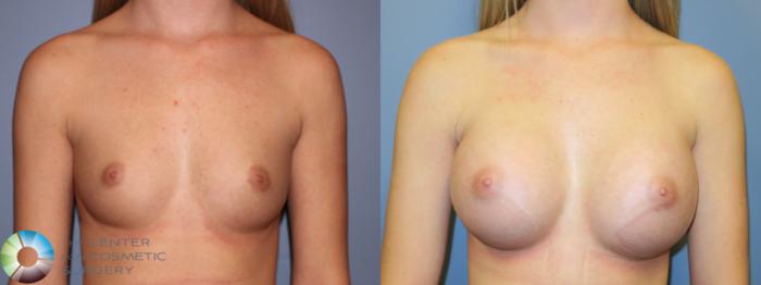 Before & After Breast Augmentation Case 11322 Front View in Golden, CO