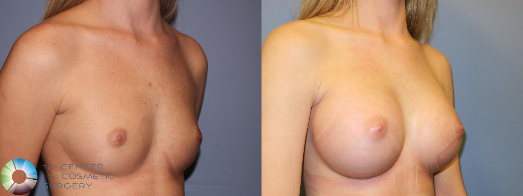 Before & After Breast Augmentation Case 11322 Right Oblique in Denver and Colorado Springs, CO