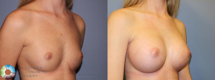 Before & After Breast Augmentation Case 11322 Right Oblique View in Golden, CO