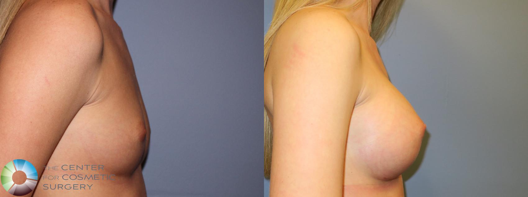 Before & After Breast Augmentation Case 11322 Right Side in Denver and Colorado Springs, CO