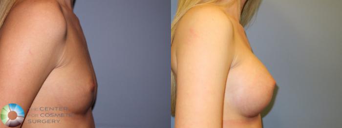 Before & After Breast Augmentation Case 11322 Right Side View in Golden, CO