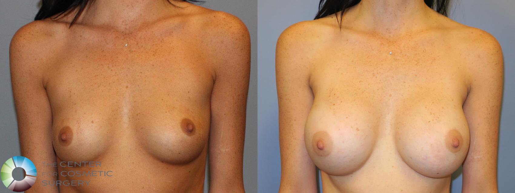 Before & After Breast Augmentation Case 11323 Front in Denver and Colorado Springs, CO