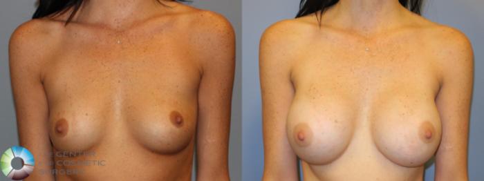 Before & After Breast Augmentation Case 11323 Front View in Golden, CO