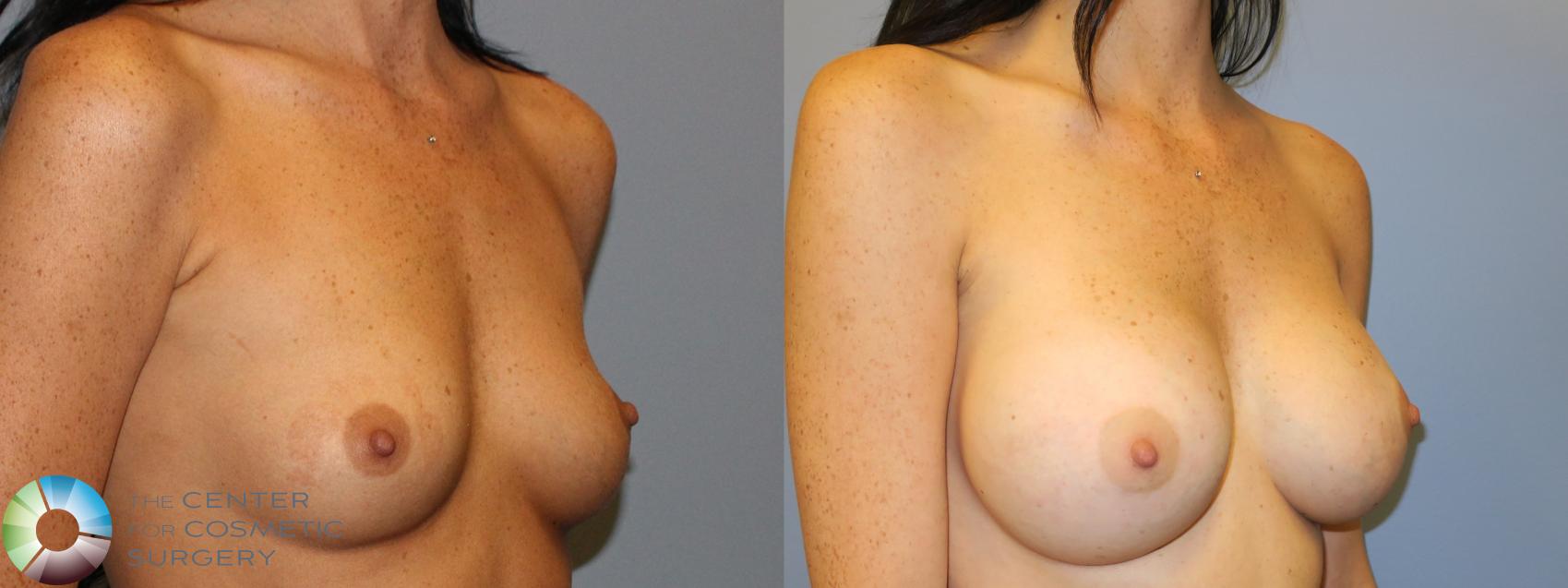 Best Denver Breast Implants/Augmentation