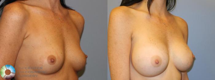 Before & After Breast Augmentation Case 11323 Right Oblique View in Golden, CO