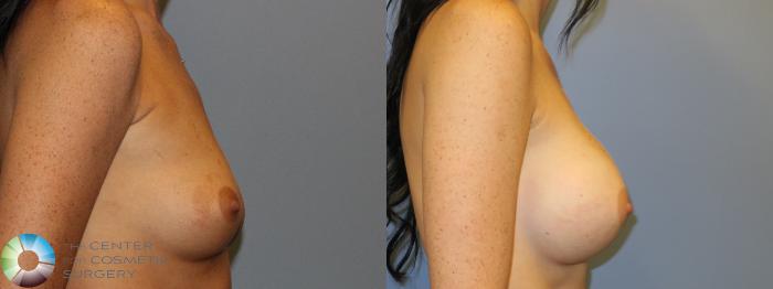 Before & After Breast Augmentation Case 11323 Right Side View in Golden, CO