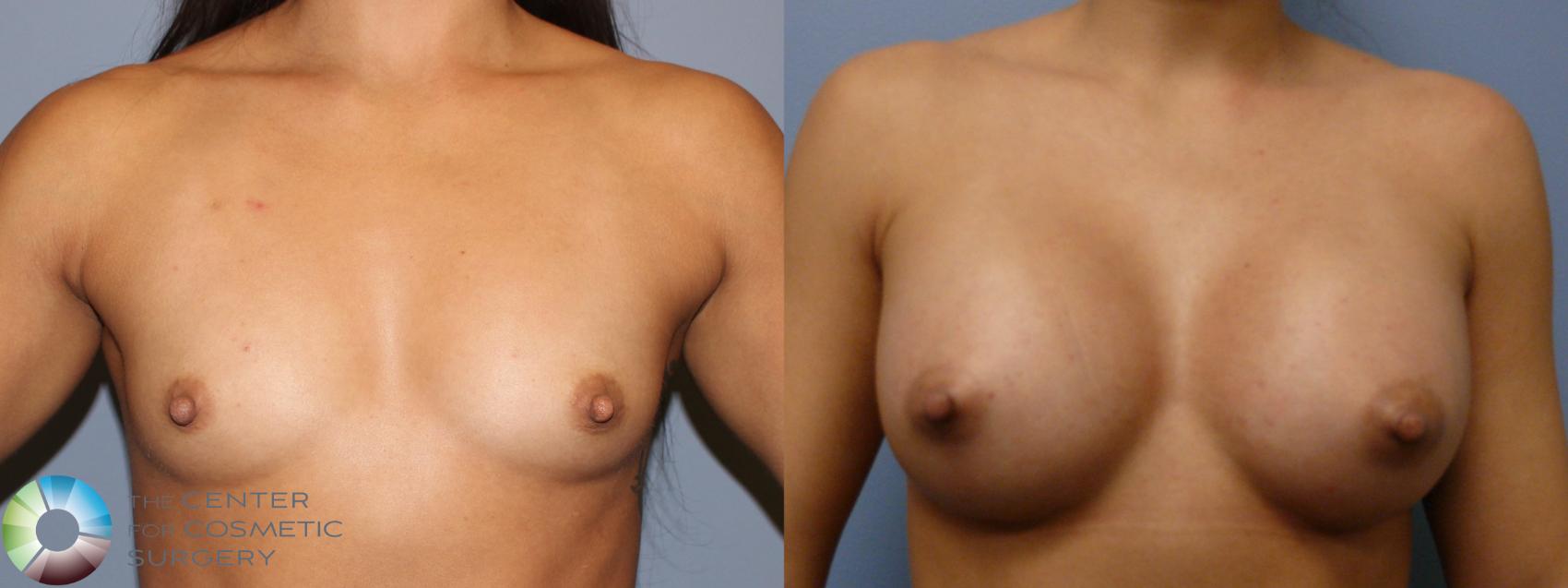 Before & After Breast Augmentation Case 11324 Front in Denver and Colorado Springs, CO