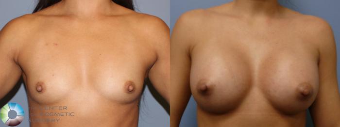 Before & After Breast Augmentation Case 11324 Front View in Golden, CO
